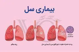 افراد دارای علامت سرفه بیش از دو هفته حتما جهت نمونه برداری به مراکز بهداشتی مراجعه نمایند 